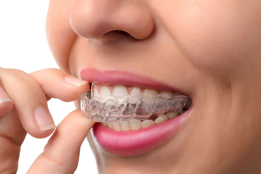 Invisalign Pros and Cons