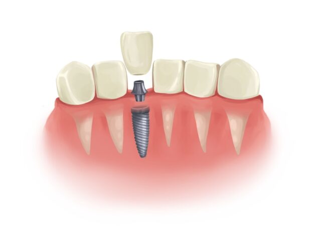 Pros and Cons of Clear Choice Dental Implants