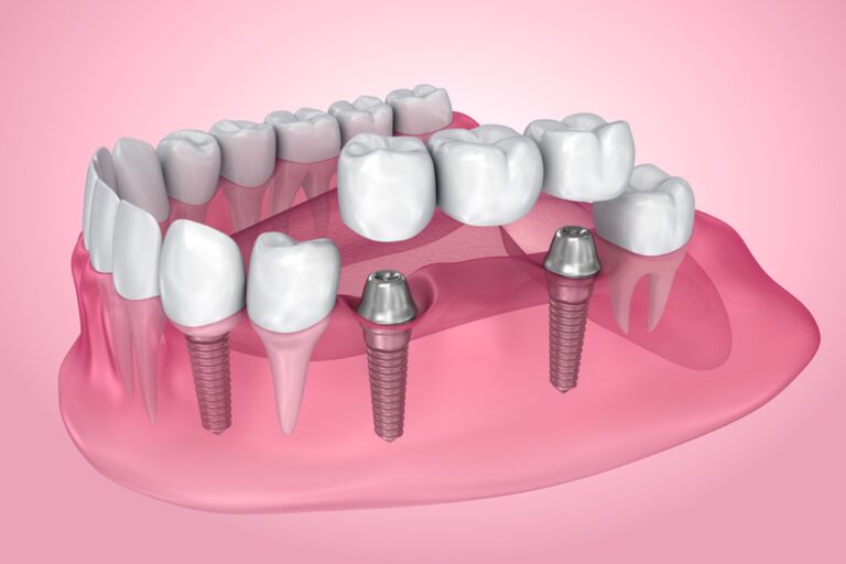 Pros and Cons of Dental Implants